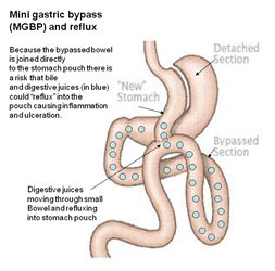 The Mini-Gastric Bypass www.clos.net/ The Mini Gastric Bypass (MGB) is a Short, Simple, Successful, Reversible Laparoscopic gastric bypass weight loss surgery